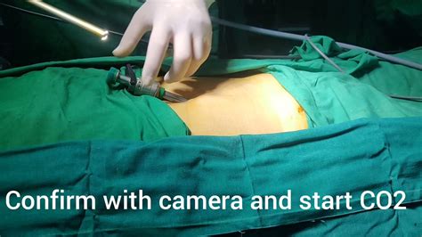 Direct Trocar Entry For Tep Repair Of Inguinal Hernia Youtube