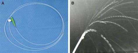 Chemical Pleurodesis Using Mistletoe Extracts Via Spray Catheter During