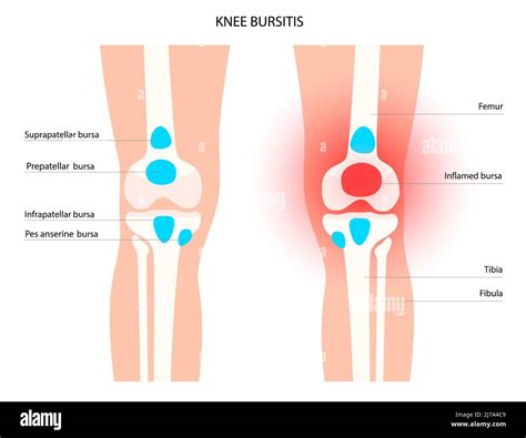 Bursitis de rodilla ilustración conceptual Fotografía de stock Alamy