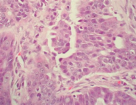 Primary Peritoneal Tumors Imaging Features With Pathologic Correlation