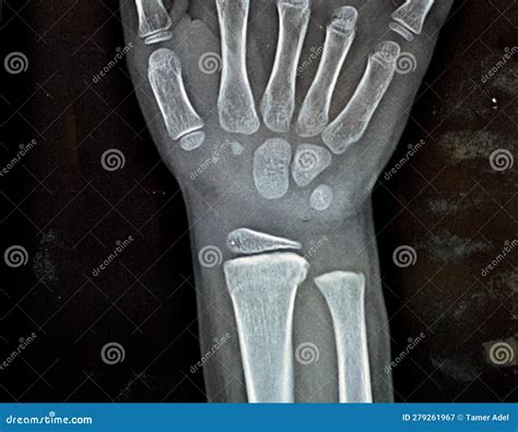 Plain X Ray Right Wrist Joint Shows Right Distal Radius Fracture