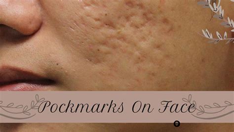 Pockmarks On Face Meaning Causes And Best Treatments