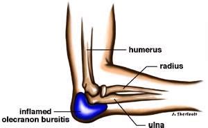 Olecranon Bursitis Pinnacle Orthopaedics