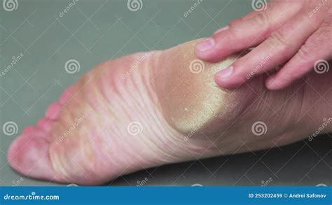 A Hand Rubs The Keratinized Skin Of The Heel Of A Man S Foot Stock