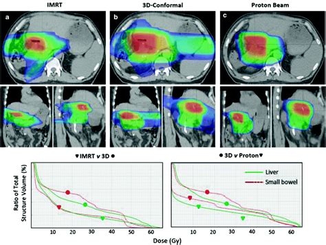 Beam Radiation Therapy 3d Conformal Intensity Modulated And Proton