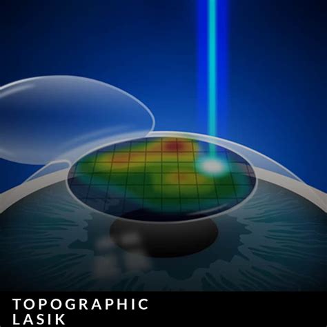 Conditions & Treatments - Laser Eye Center