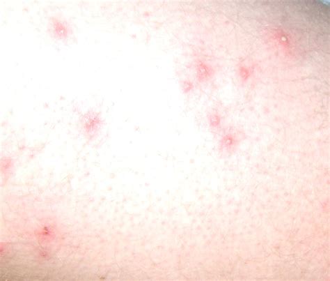 Folliculitis - Pictures, Symptoms, Causes, Treatment