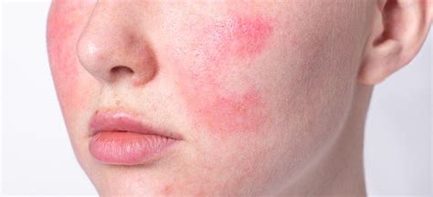 Rosacea Treatment 6 Natural Remedies To Use Dr Axe