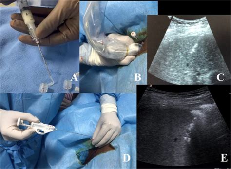 Endoscopic Ultrasound Guided Liver Biopsy Missing The Limitations In