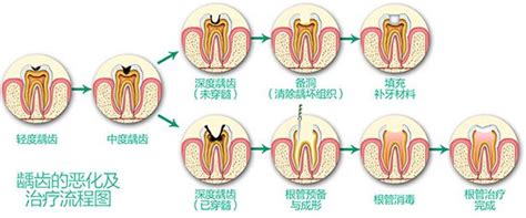 蛀牙治疗流程 爱康健齿科