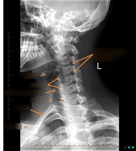 X Ray Oblique View Of Cervical Spine 2 Diagram Quizlet