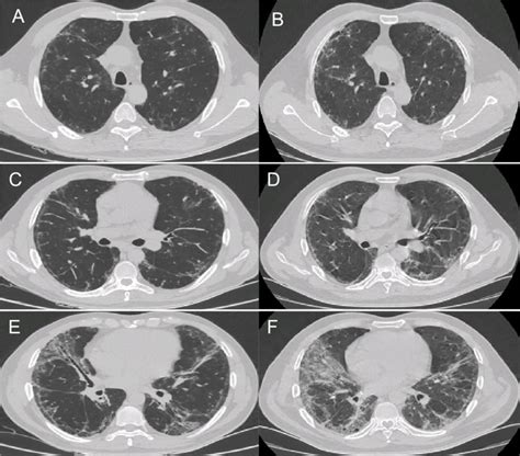 Progressive Pulmonary Fibrosis Due To Fibrotic Nonspecific Interstitial