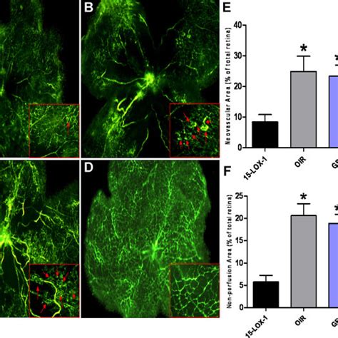 The Inhibitory Effect Of 15 Lox 1 Overexpression On Retinal