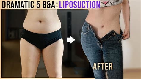 Outstanding Body Liposuction Before And After Results In Korea Plastic