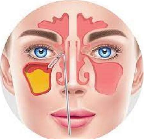 Sinus Headache: Symptoms, Causes, Diagnose, and treatment - Riffatshazia - Medium