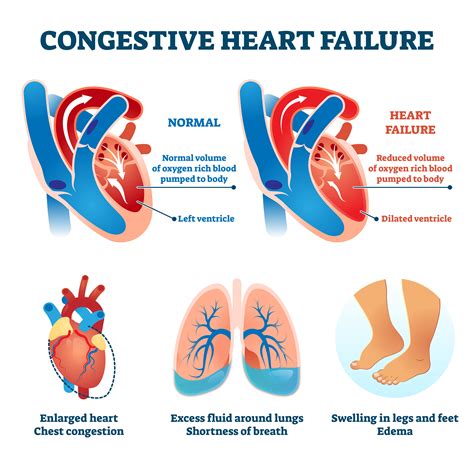 Heart Failure Program Q A