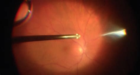 Pars Plana Vitrectomy Wills Eye Library