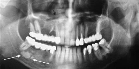 A Case With 2 Radiopacities In The Edentulous Molar Area Of The Fourth