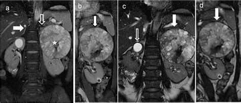 Mri Of Kidney Mass