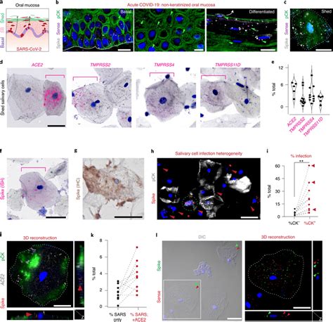 Oral Mucosal Epithelial Cells Are Infected By SARS CoV 2 And Shed Into