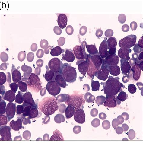 Acute Myeloid Leukemia With Myelodysplasia Related Changes With Blasts