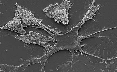 Cancer Cell Electron Microscopy