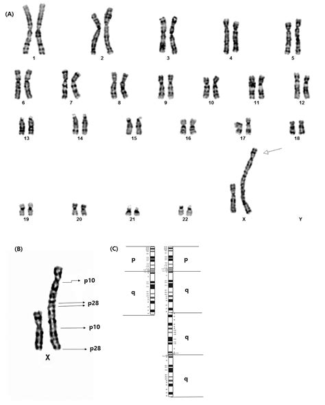 Fragile X Syndrome Karyotype