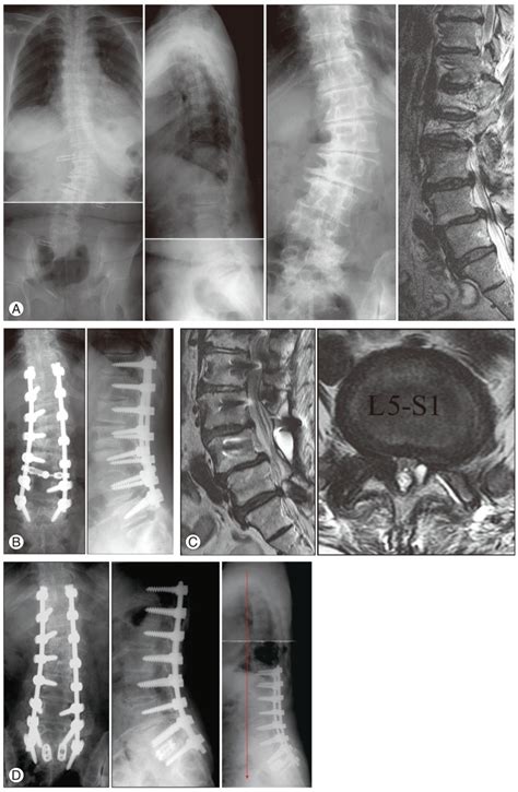 Long Fusion And Fixation To The Sacrum With Correction Of Deformity