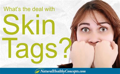 Skin Tags - What are They & How You Get Rid of Them - Healthy Concepts ...