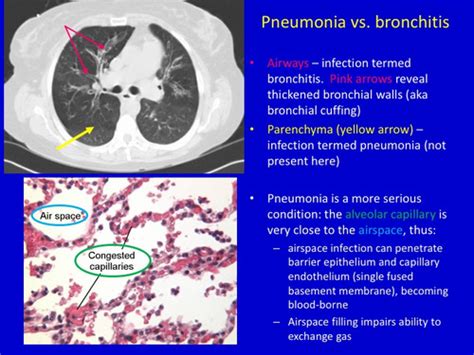 How To Diagnose Pneumonia Flashcards Quizlet