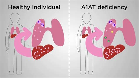 An Ultimate Mouse Model Of Gene Therapy For Alpha 1 Antitrypsin