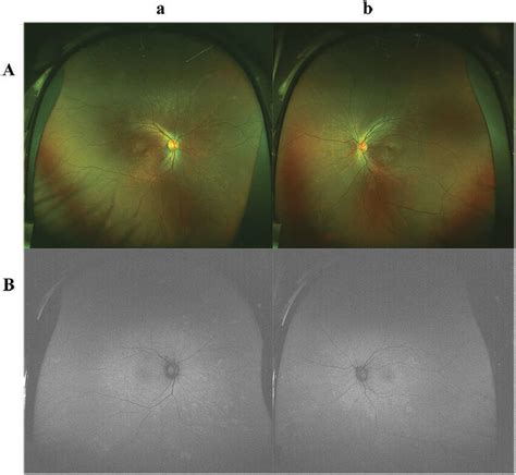 Fundus Photography And Fundus Autofluorescence FAF Findings A