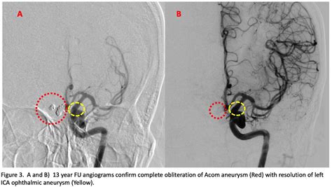 Brain Aneurysms - Multiple Ruptured - Neurointerventional Medicine PLLC