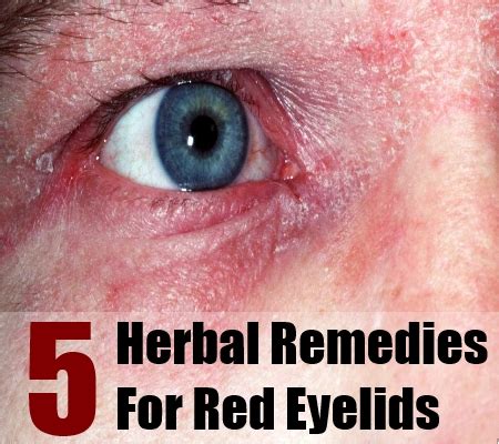 Top 5 Herbal Remedies For Red Eyelids – Natural Home Remedies & Supplements