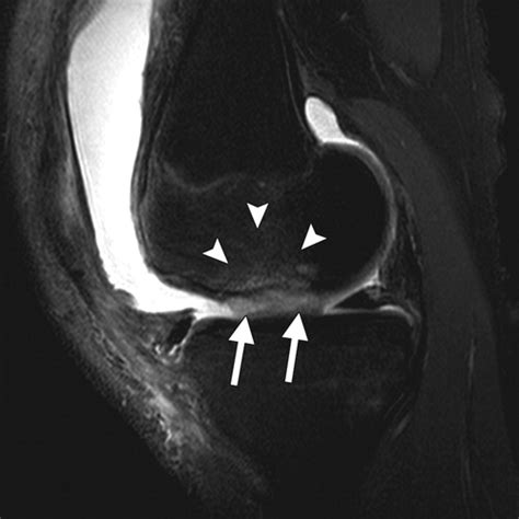 Articular Cartilage In The Knee Current Mr Imaging Techniques And