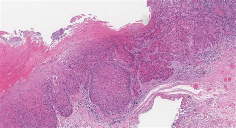 Squamous Cell Carcinoma Of The Larynx Ottawa Atlas Of Pathology