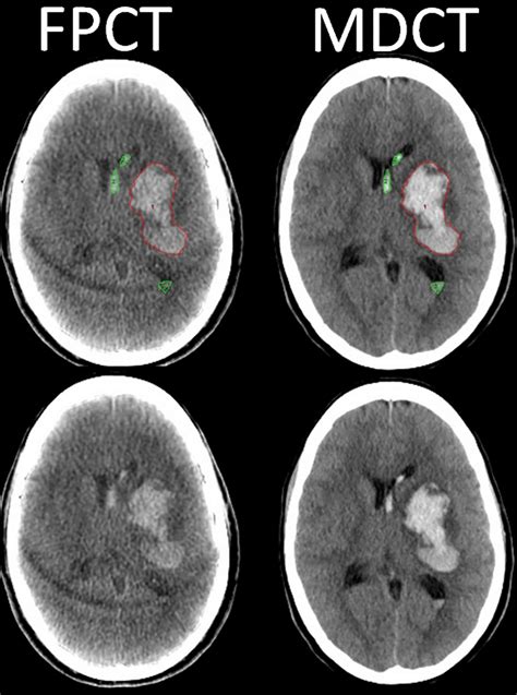 Depiction Of Intracranial Hemorrhage On FPCT And MDCT Figure Shows