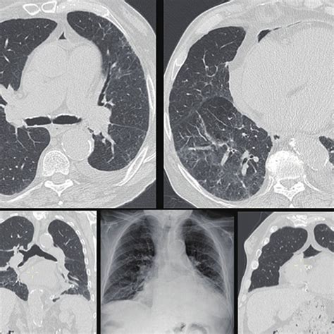 The chest CT scan carried out 5 days after the pericardial window, with ...