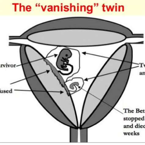 Vanishing Twin Syndrome