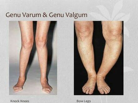 Knee abnormalities | Knock knees, Genu varum, Genu valgum