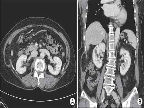 How is abdominal hernia diagnosed? - Dr Abdollah Zandi