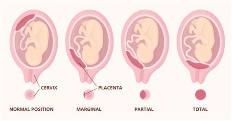 Placenta Accreta Diagram