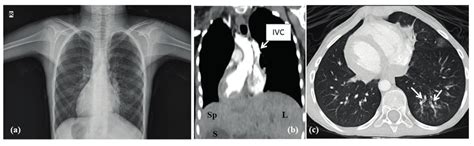 A Posteroanterior Chest X Ray Showing Dextrocardia B Radiological