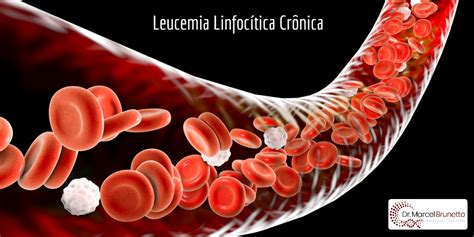 Leucemia Linfoc Tica Cr Nica Fb