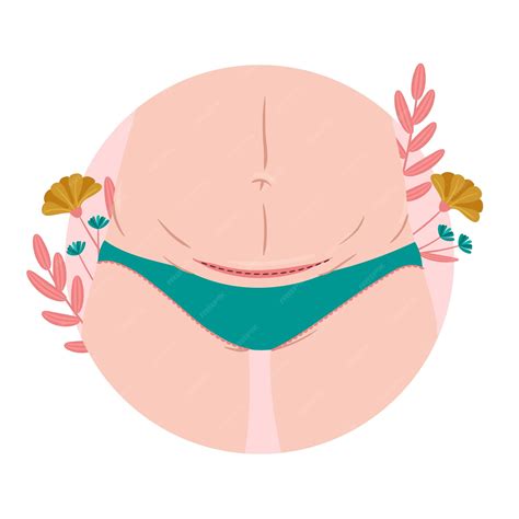 Free Vector | Flat design cesarean section incision