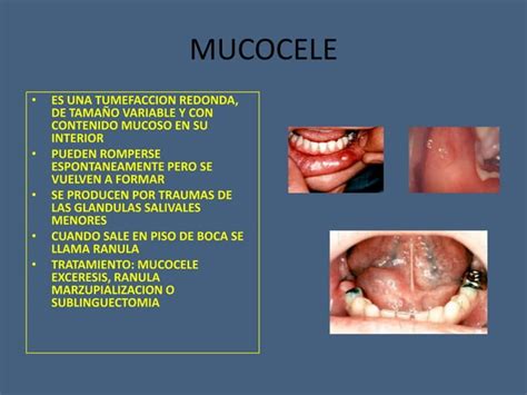 Tumores Benignos Y Malignos De Cavidad Oral Ppt