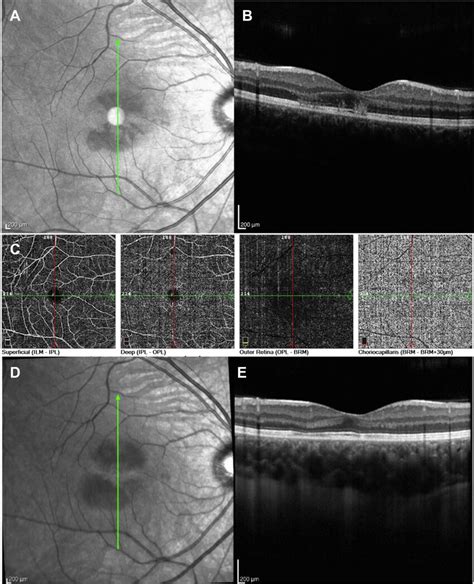 Multimodal Imaging Of The Right Eye From A 19 Year Old Woman Table S2