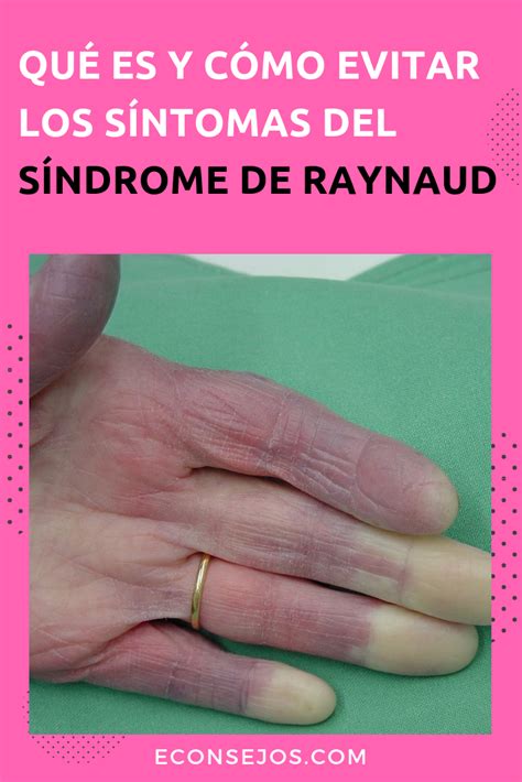 Síndrome De Raynaud Que és Cuáles Son Los Síntomas Y Cómo Evitarlo