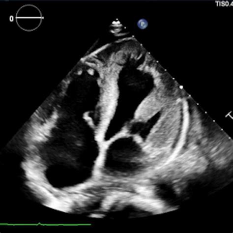 Echocardiogram Indicated Significant Left Ventricular Hypertrophy