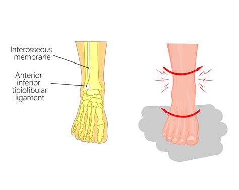 Syndesmosis Ankle Sprain